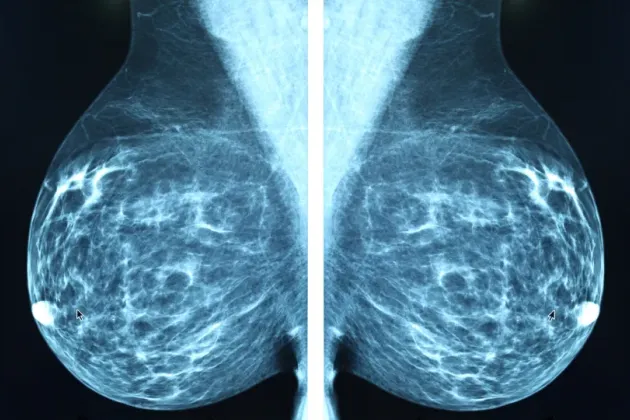 X-ray of breast tissue.